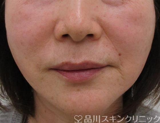 症例NO.41092のAFTER写真