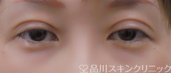 症例NO.38393のAFTER写真