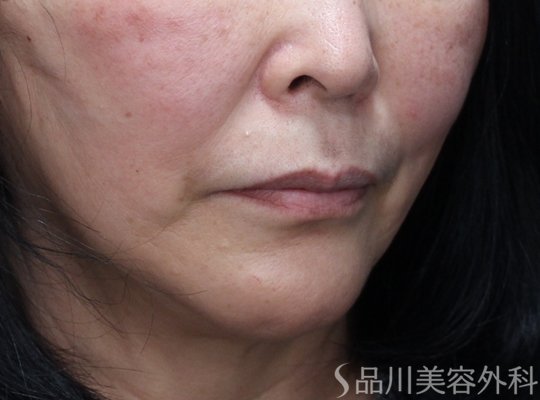 症例NO.72985のAFTER写真