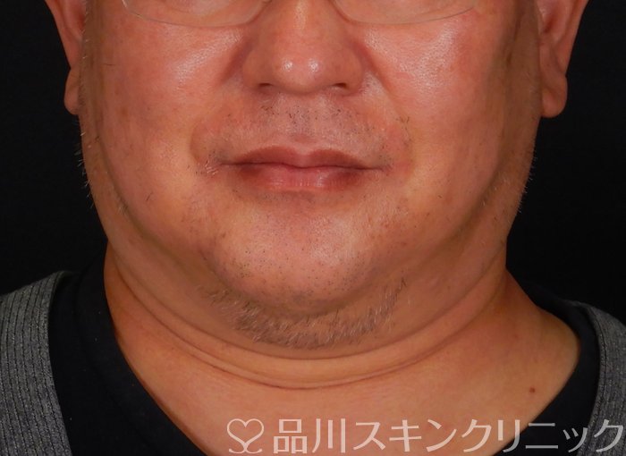 症例NO.65724のBEFORE写真