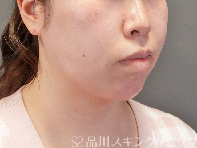 症例NO.63310のAFTER写真