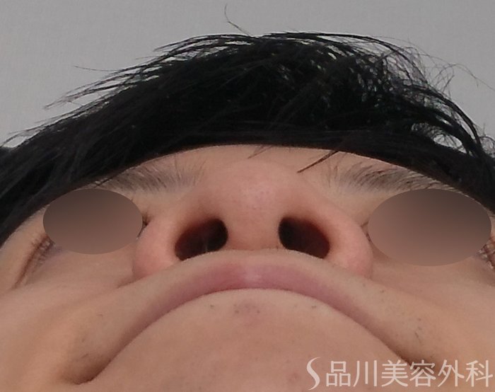 症例NO.70330のBEFORE写真