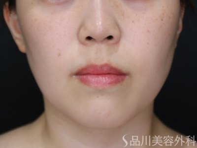 症例NO.72167のBEFORE写真