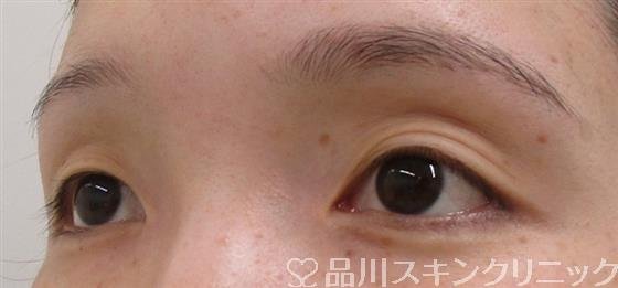 症例NO.42340のBEFORE写真