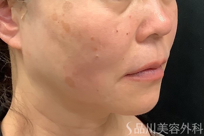 症例NO.73321のAFTER写真