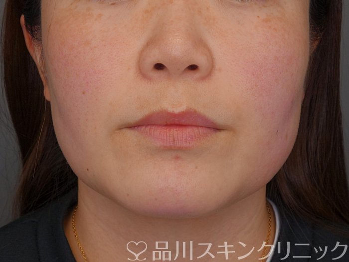 症例NO.74567のBEFORE写真