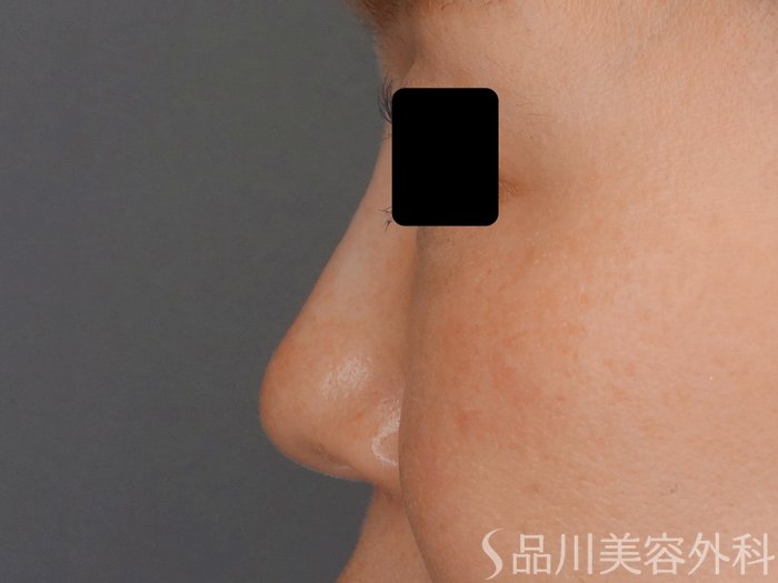 症例NO.64395のAFTER写真