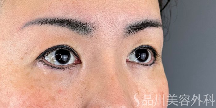 症例NO.69462のBEFORE写真