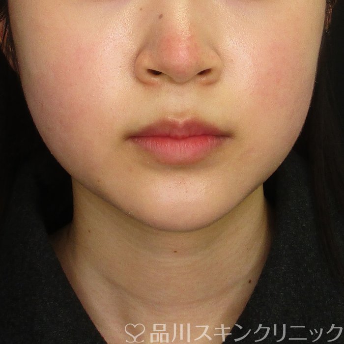 症例NO.70333のAFTER写真