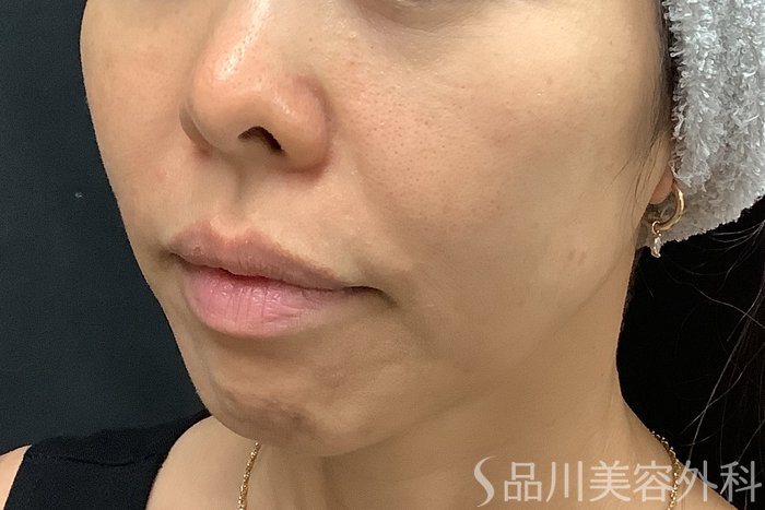 症例NO.71240のBEFORE写真