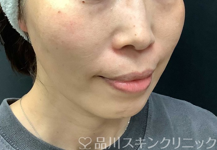症例NO.71036のAFTER写真