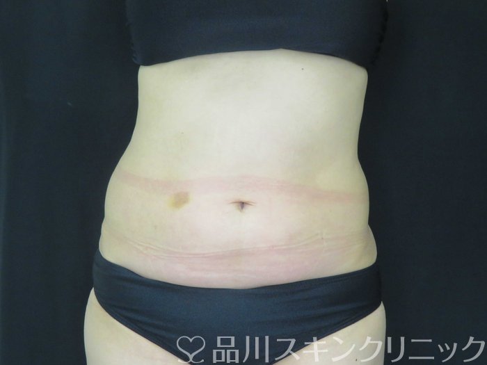 症例NO.68018のBEFORE写真
