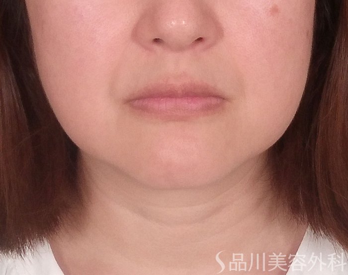 症例NO.70612のBEFORE写真