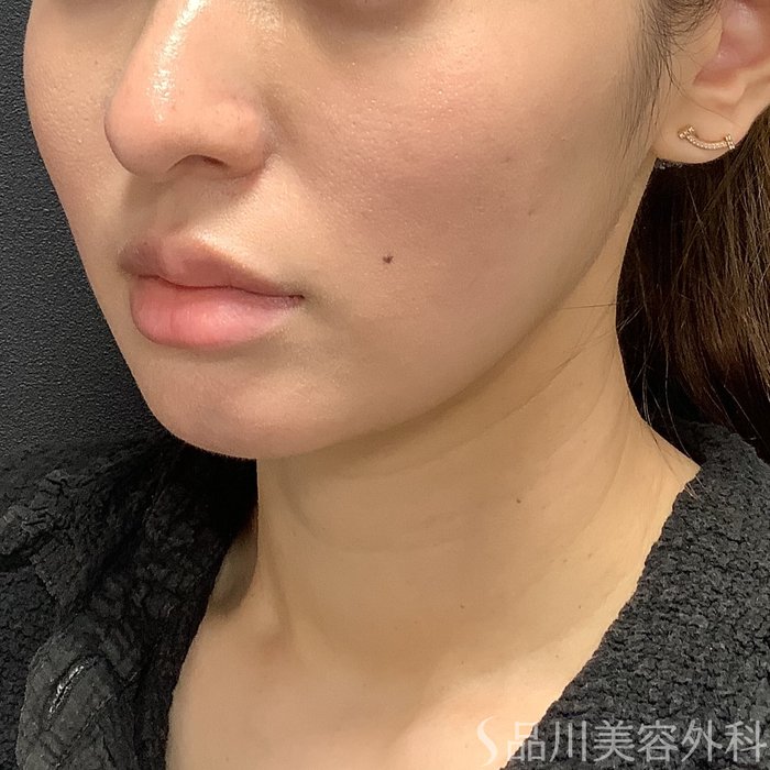 症例NO.75326のAFTER写真
