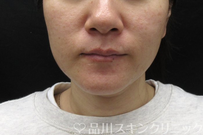 症例NO.74488のBEFORE写真