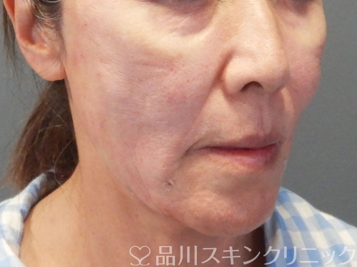 症例NO.69477のAFTER写真