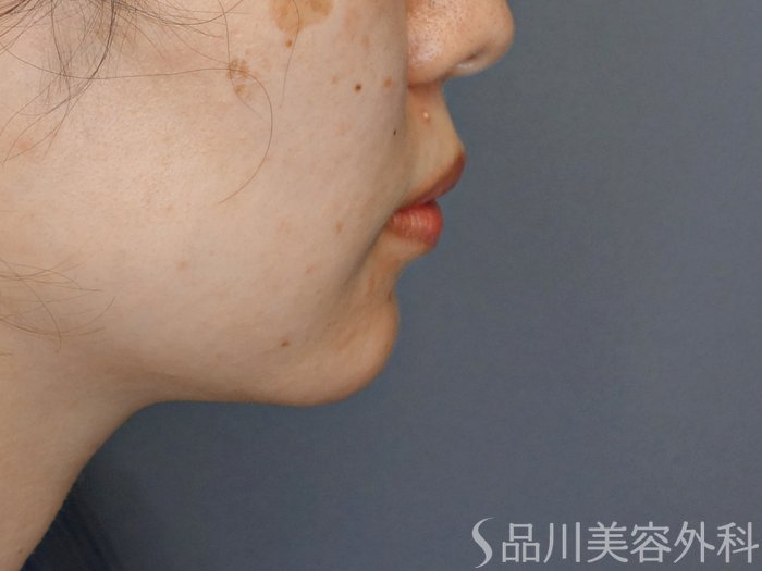 症例NO.71272のBEFORE写真