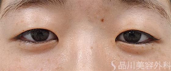 症例NO.51051のBEFORE写真