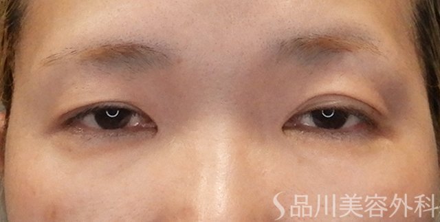 症例NO.75109のBEFORE写真