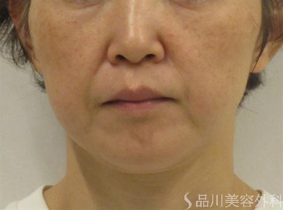 症例NO.45413のBEFORE写真