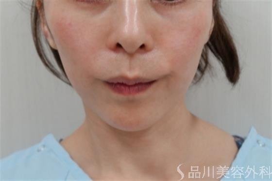 症例NO.32474のAFTER写真