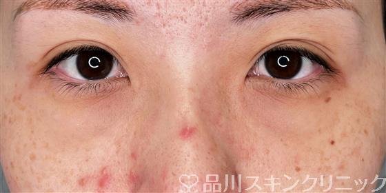 症例NO.55876のBEFORE写真