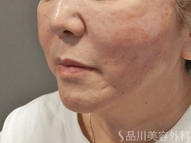 症例NO.73851のAFTER写真