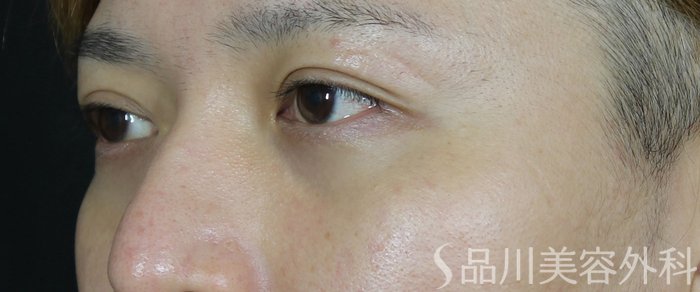 症例NO.72012のAFTER写真