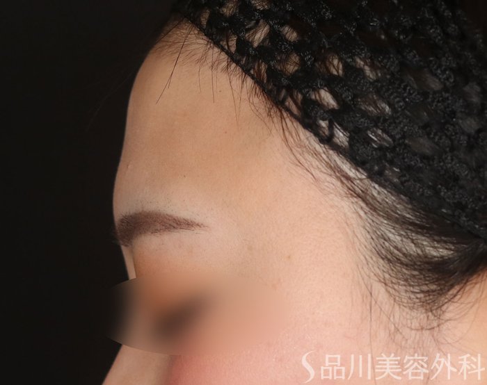 症例NO.73406のBEFORE写真