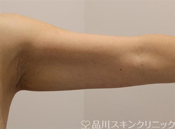症例NO.46843のAFTER写真