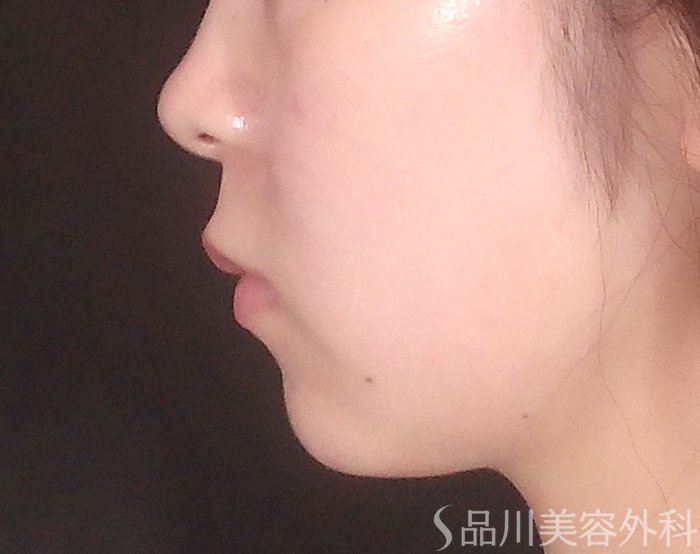 症例NO.70625のBEFORE写真
