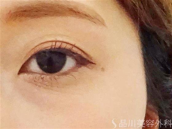 症例NO.57535のBEFORE写真