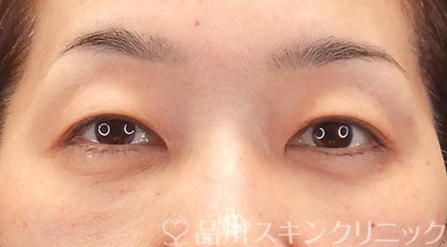 症例NO.75318のAFTER写真