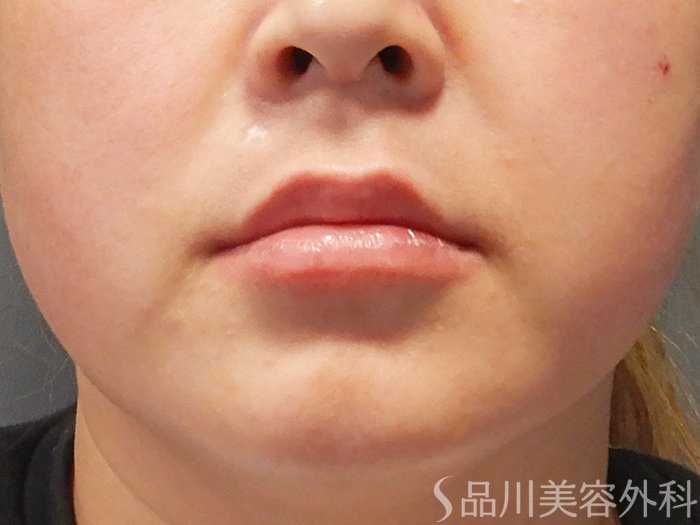 症例NO.68026のAFTER写真