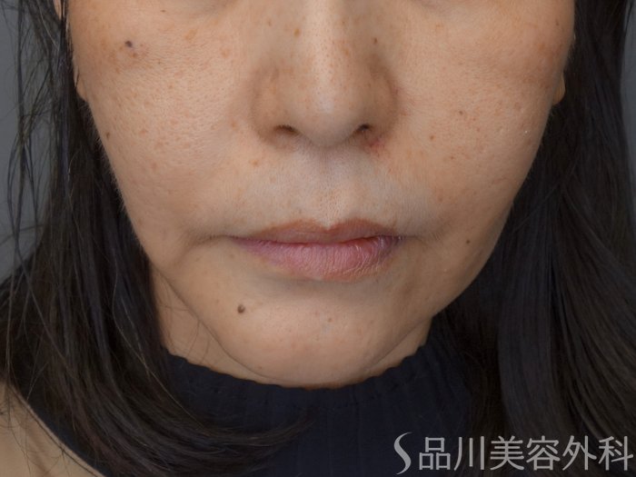 症例NO.69761のBEFORE写真