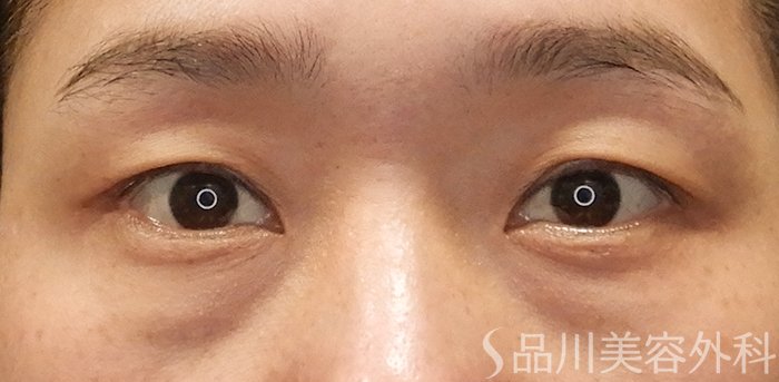 症例NO.71337のBEFORE写真