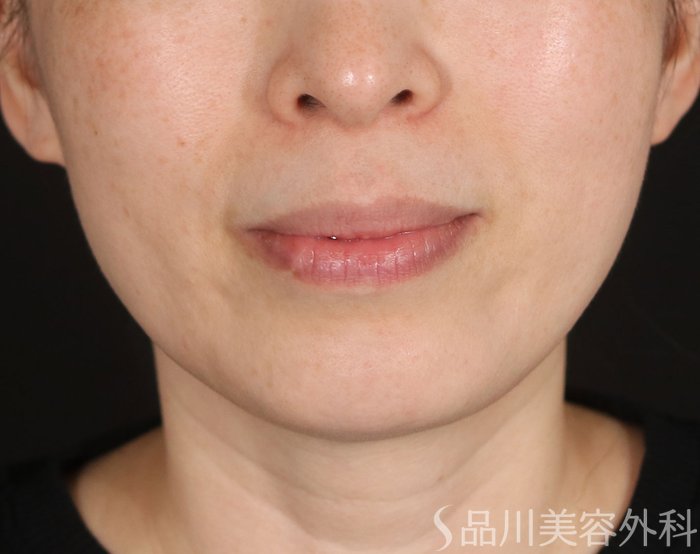 症例NO.73777のBEFORE写真