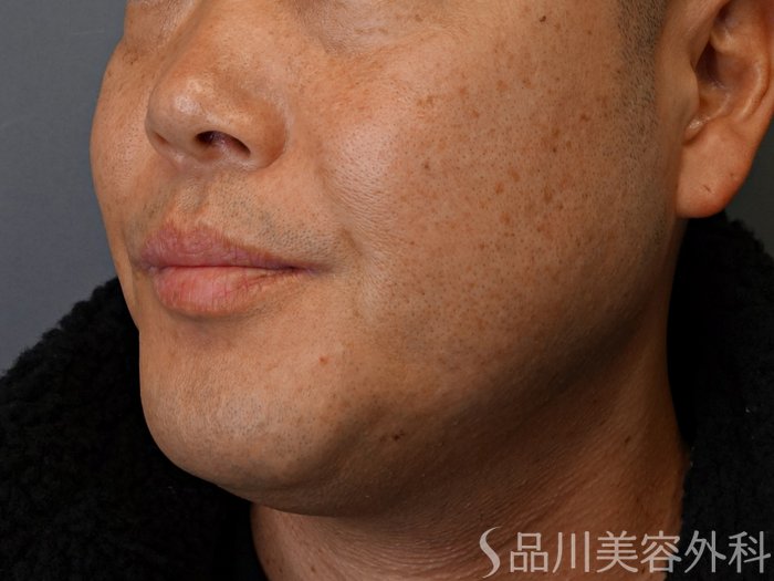 症例NO.74344のBEFORE写真
