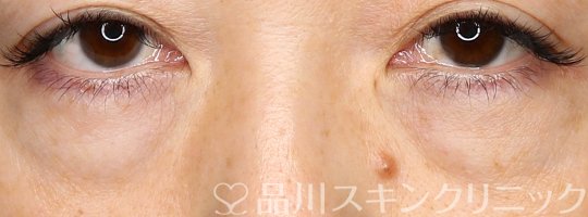 症例NO.74429のBEFORE写真