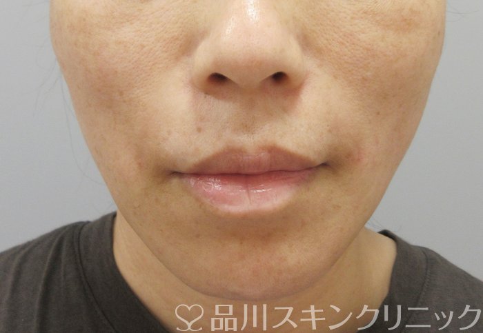 症例NO.71729のAFTER写真