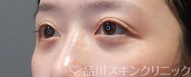 症例NO.71913のAFTER写真