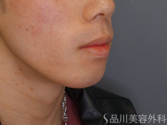 症例NO.70593のBEFORE写真