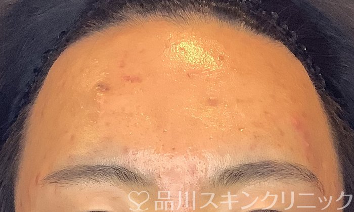 症例NO.70389のBEFORE写真