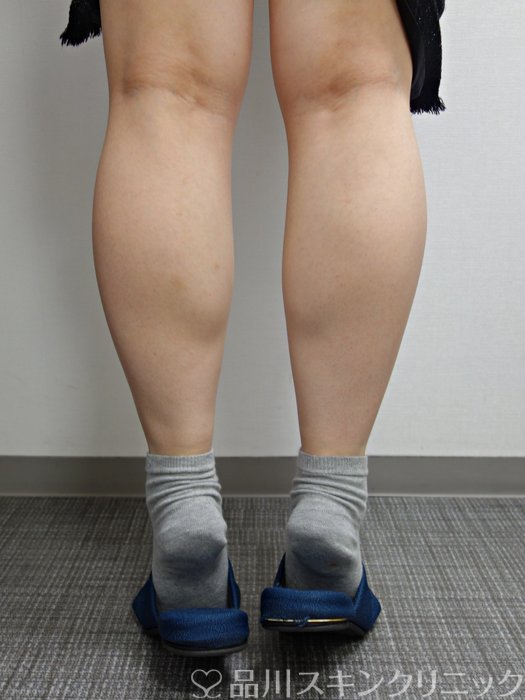 症例NO.75377のBEFORE写真