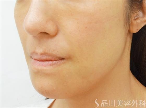 症例NO.30986のAFTER写真