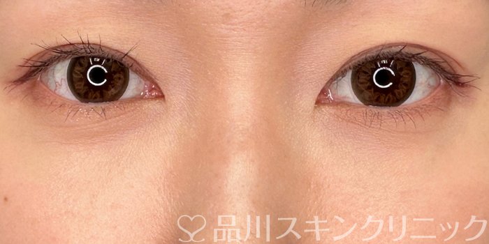 症例NO.64951のAFTER写真