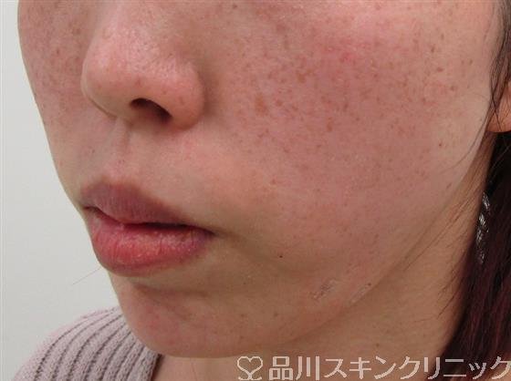 症例NO.34452のAFTER写真