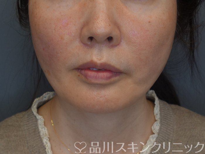 症例NO.74216のAFTER写真
