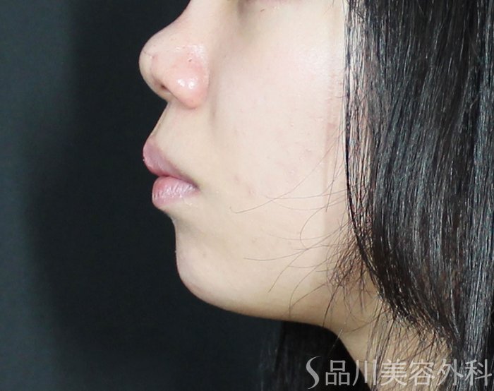 症例NO.72509のAFTER写真