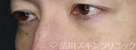 症例NO.65104のAFTER写真